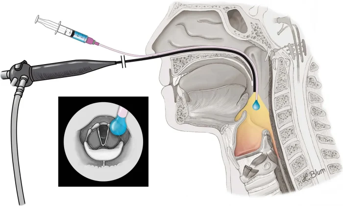 اختلال بلع مجهز به دستگاه fees در کرمان